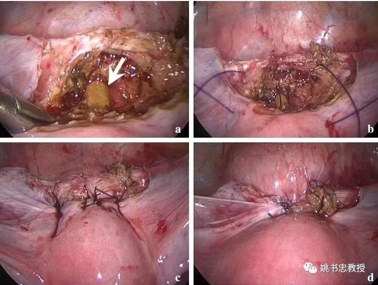 糖尿病人汞中毒_糖尿病汞中毒症状及后果_糖尿病汞中毒严重吗
