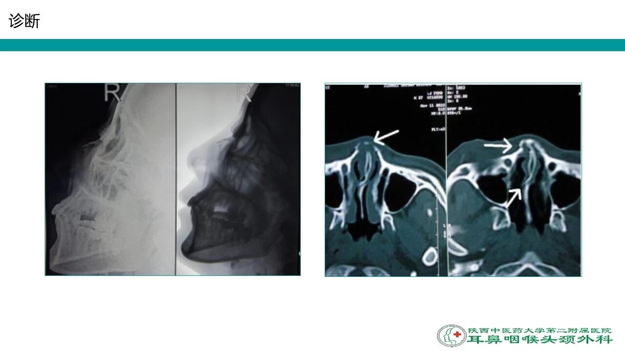 鼻骨骨折 好大夫在线 鼻骨骨折 好大夫在线