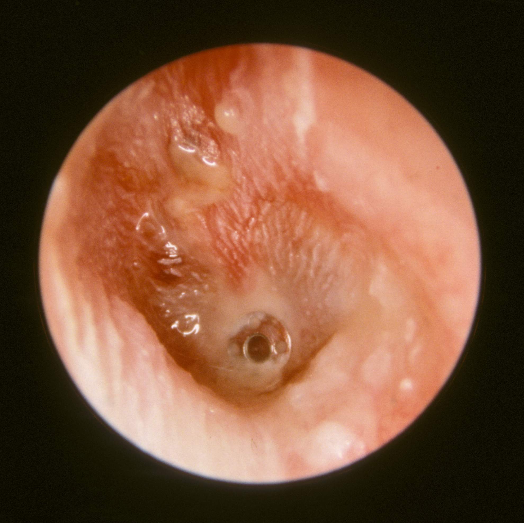 中耳炎脓性分泌物图片图片