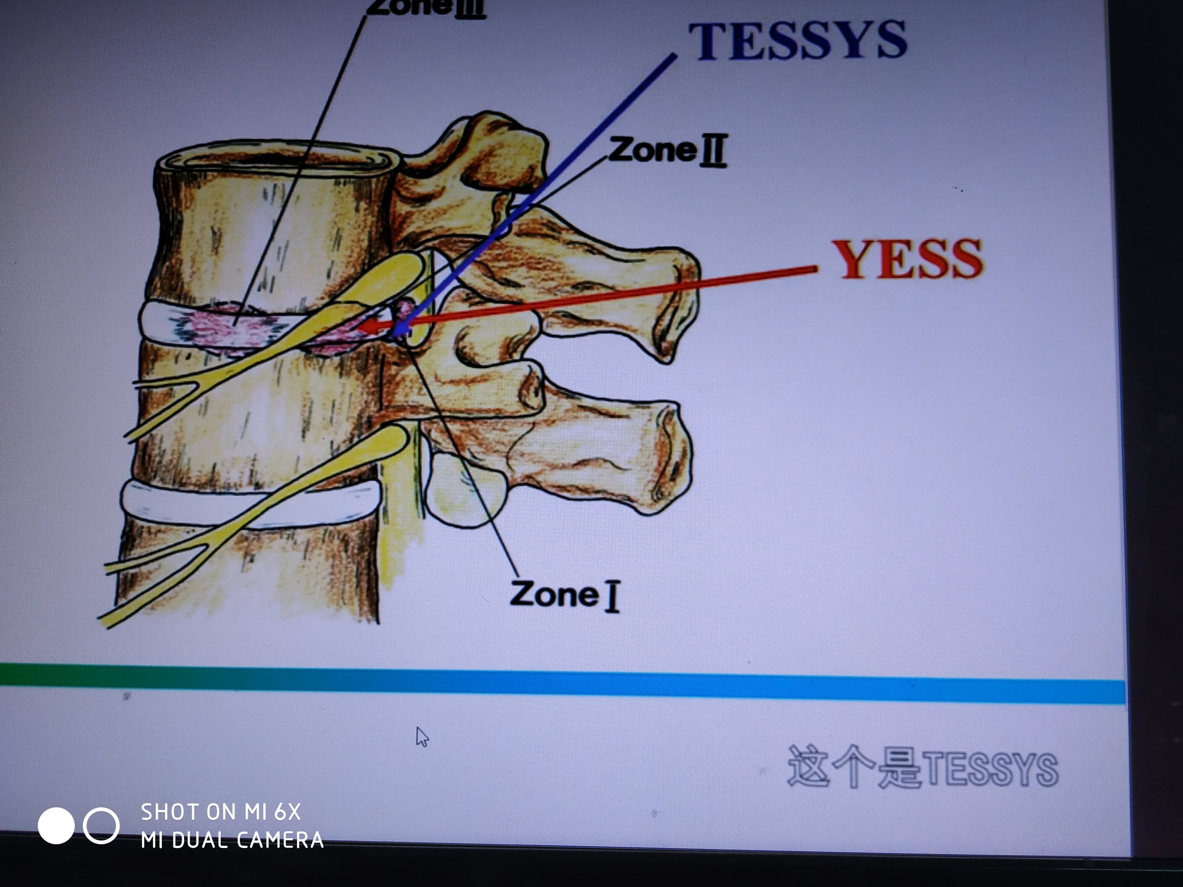 tessys技術l5s1(右)穿刺針與背平面成25-30度tessys技術tessys技術