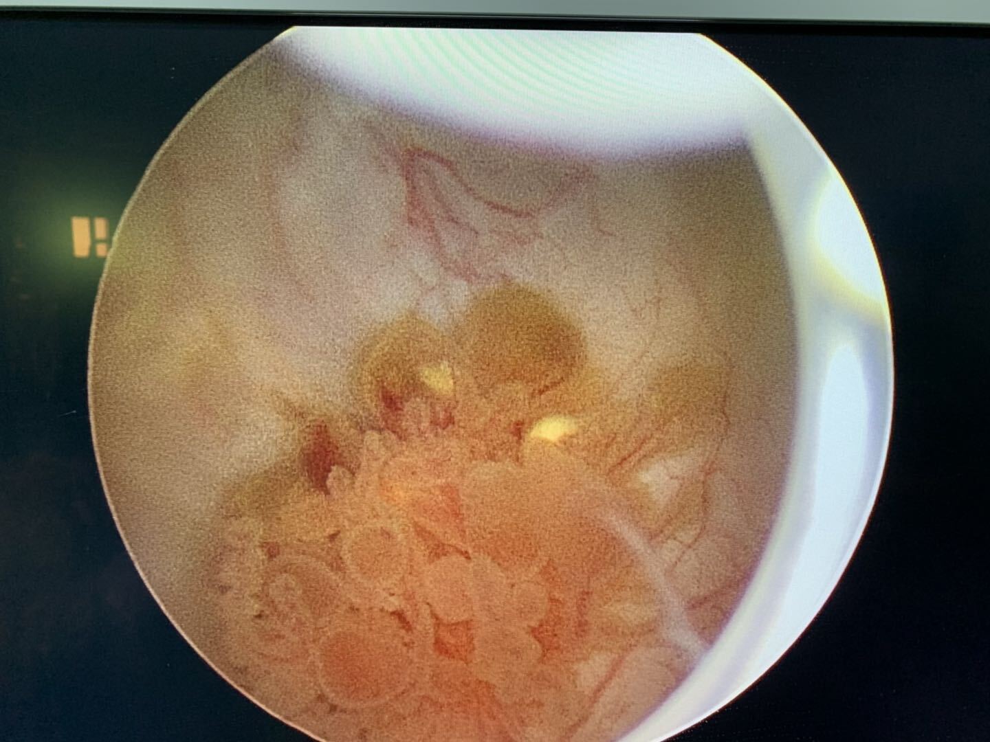 如何预防输尿管,膀胱肿瘤?_输尿管肿瘤