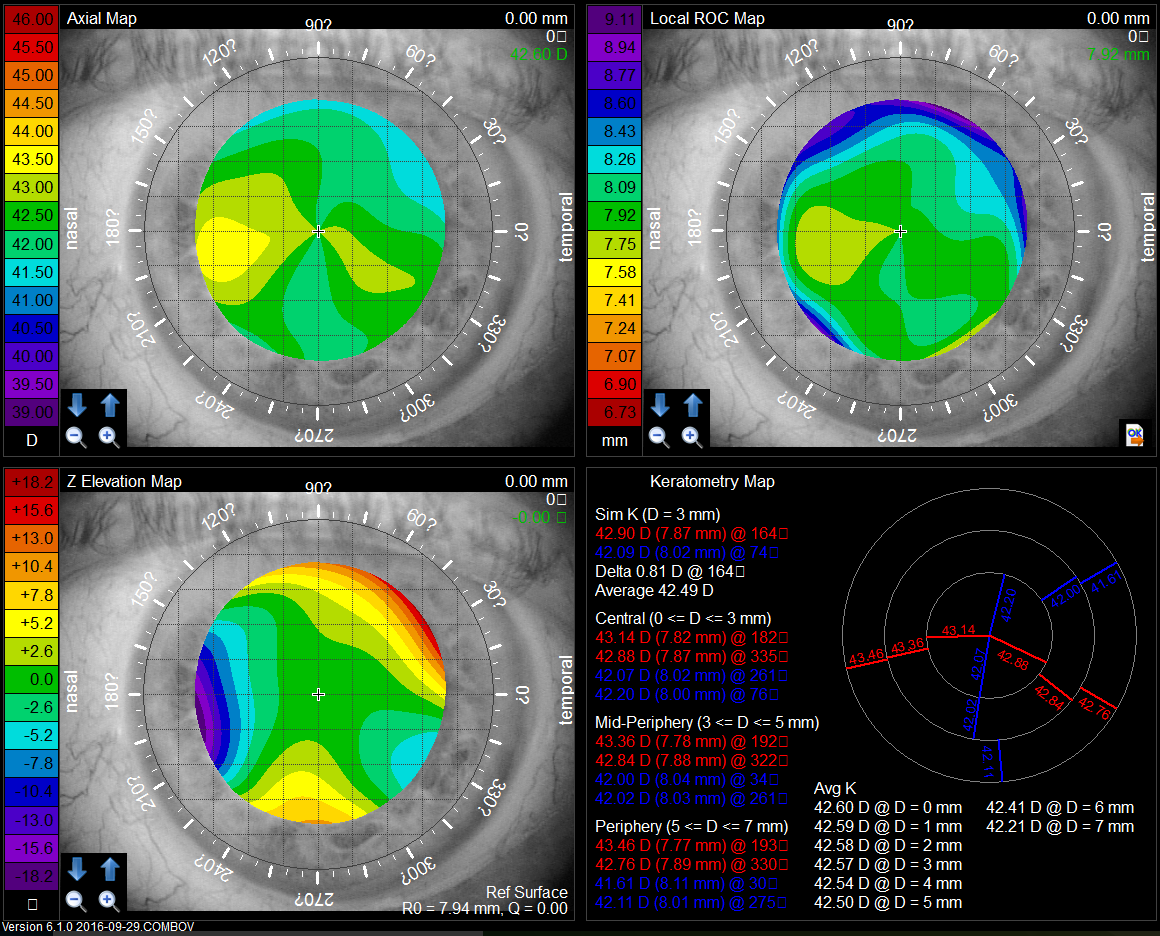 角膜地形图&像差原理解读(上) - 好大夫在线