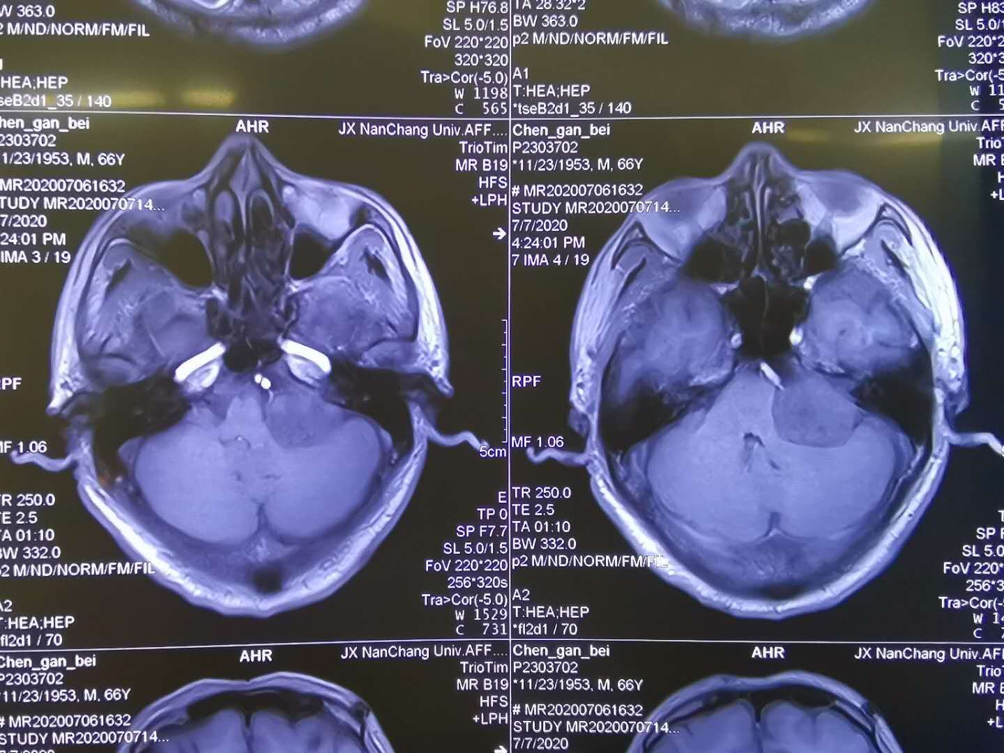 桥小脑角区肿瘤图片