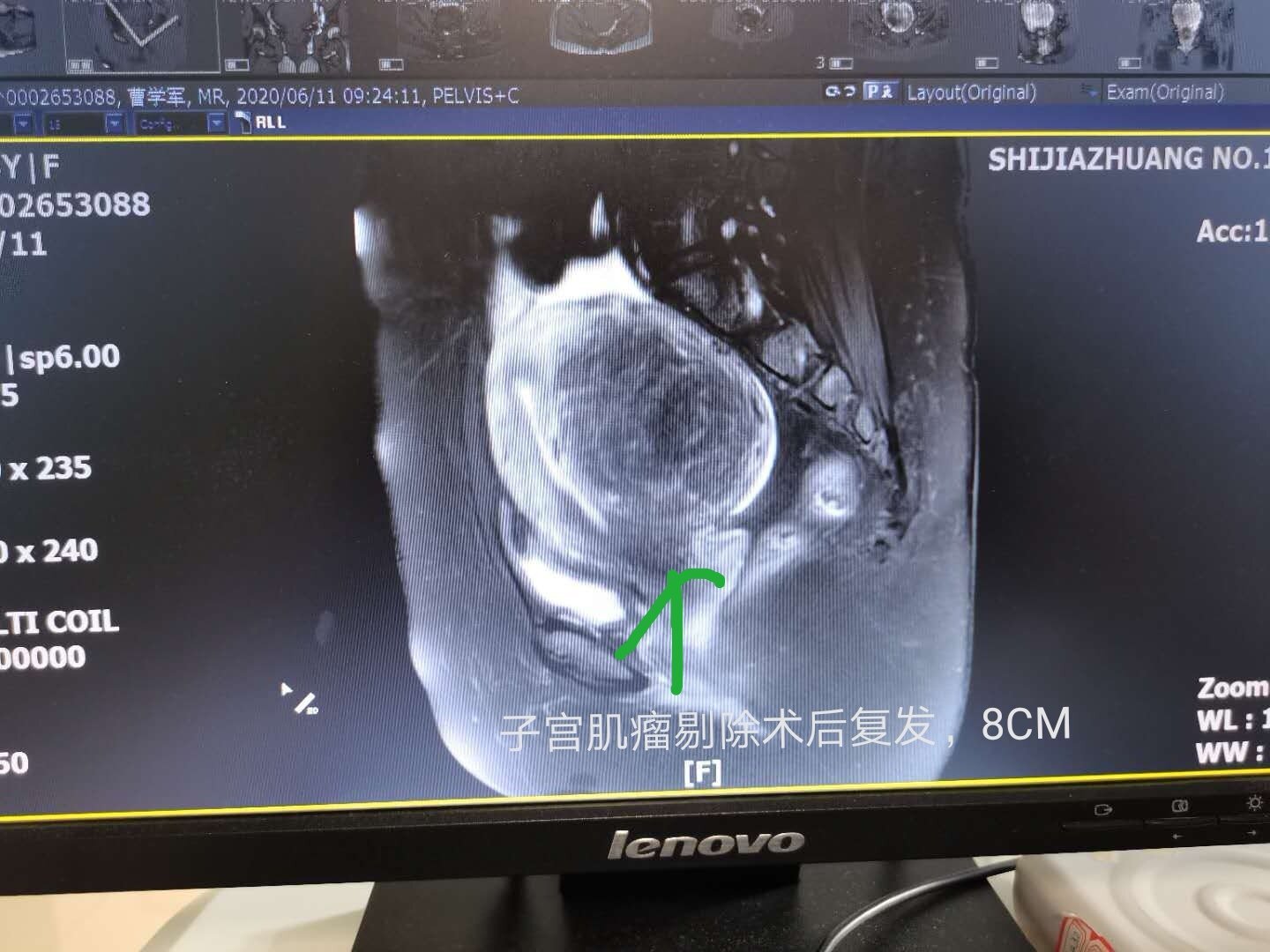 海扶不用開刀治療複發性子宮肌瘤