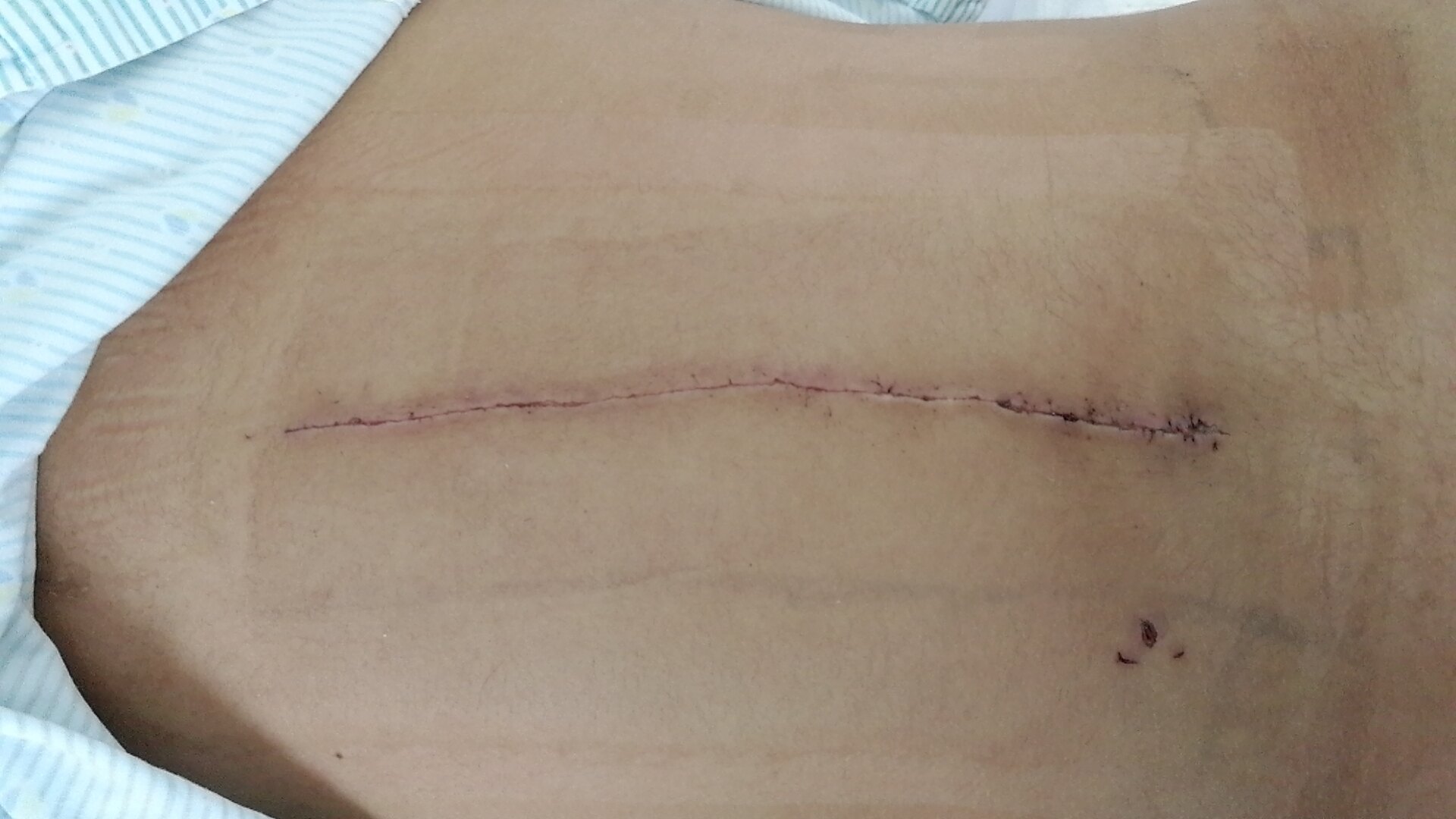 脊柱侧弯手术切口术后都是一条线不是蜈蚣