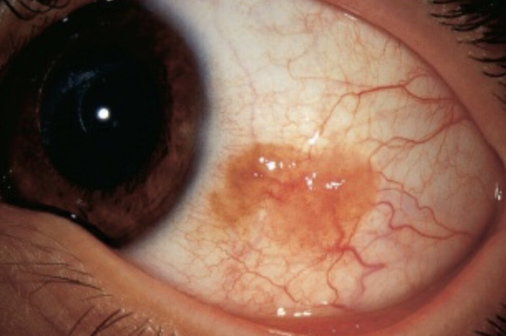 良性眼肿瘤图片图片