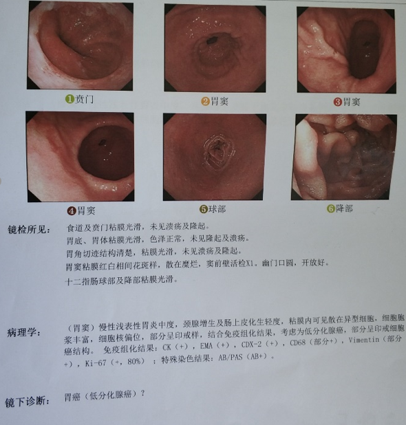 第一次胃镜 该患者为63岁男性