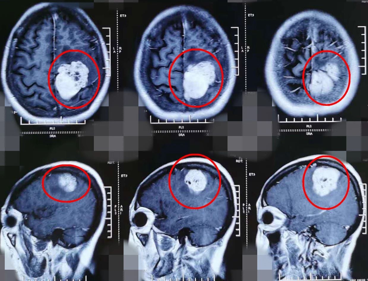 腦膜瘤患者為什麼做完頭顱ct還要做磁共振