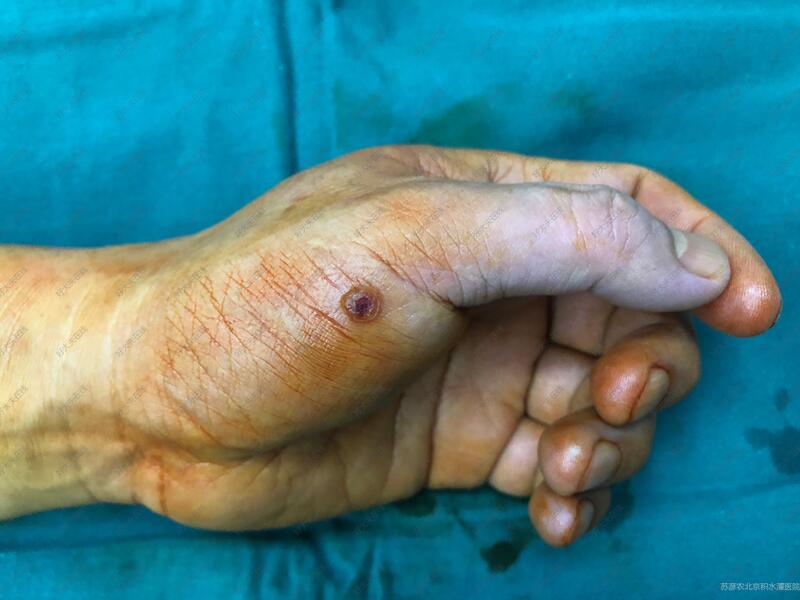 大拇指血管瘤图片图片