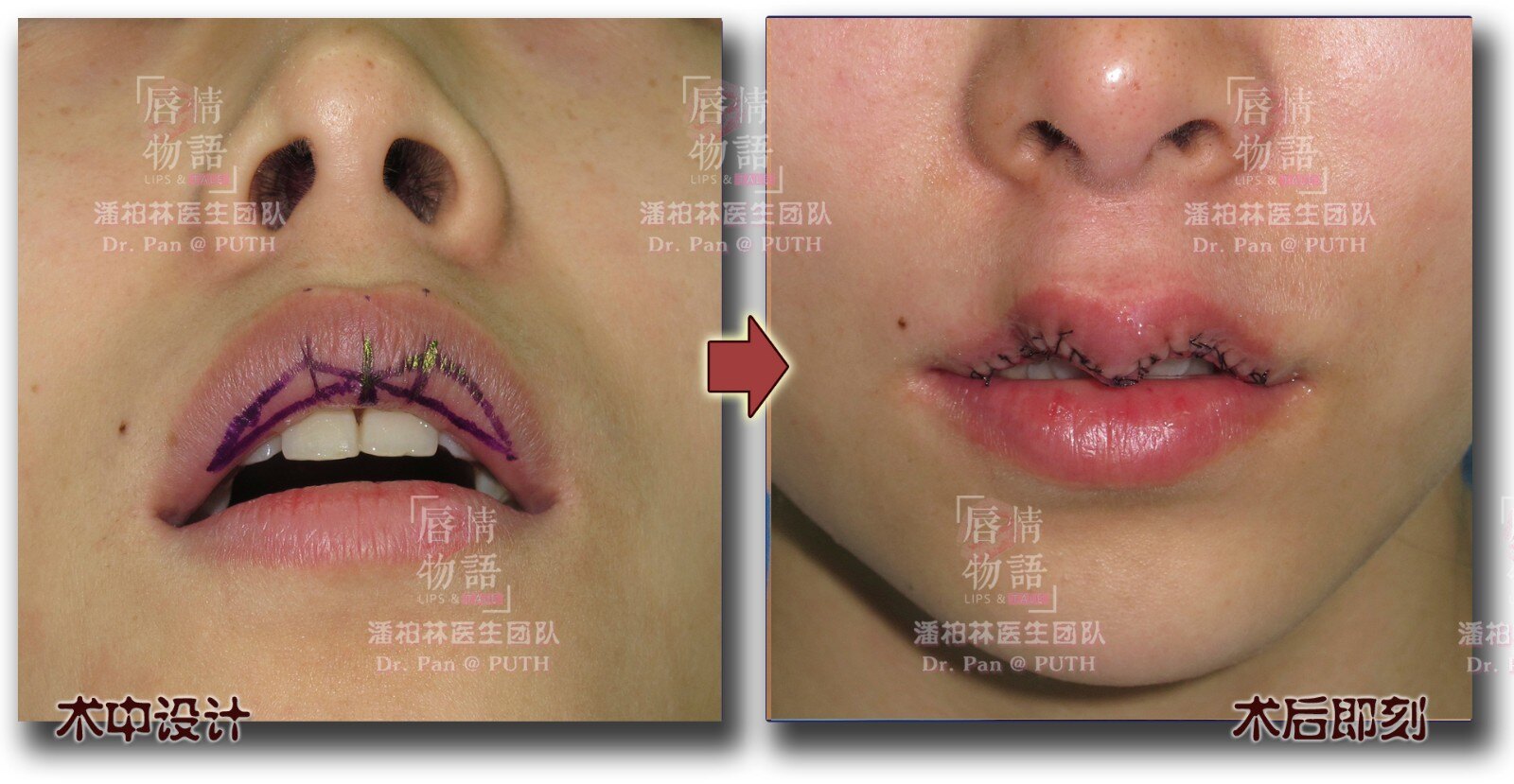 上唇综合整形(upper lip vermilion plasty:修薄/m唇/Ω唇