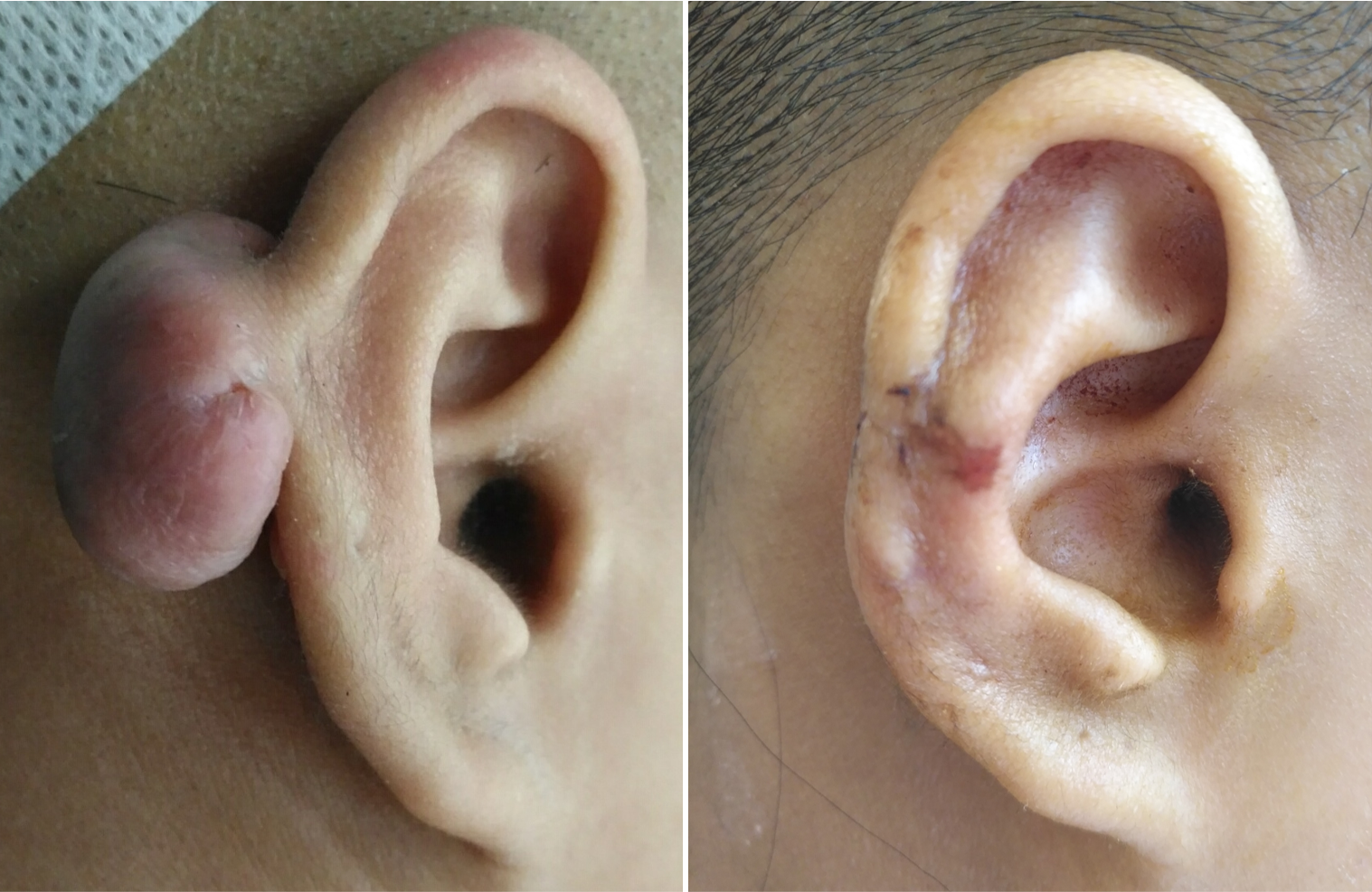 耳廓瘢痕疙瘩的手术治疗