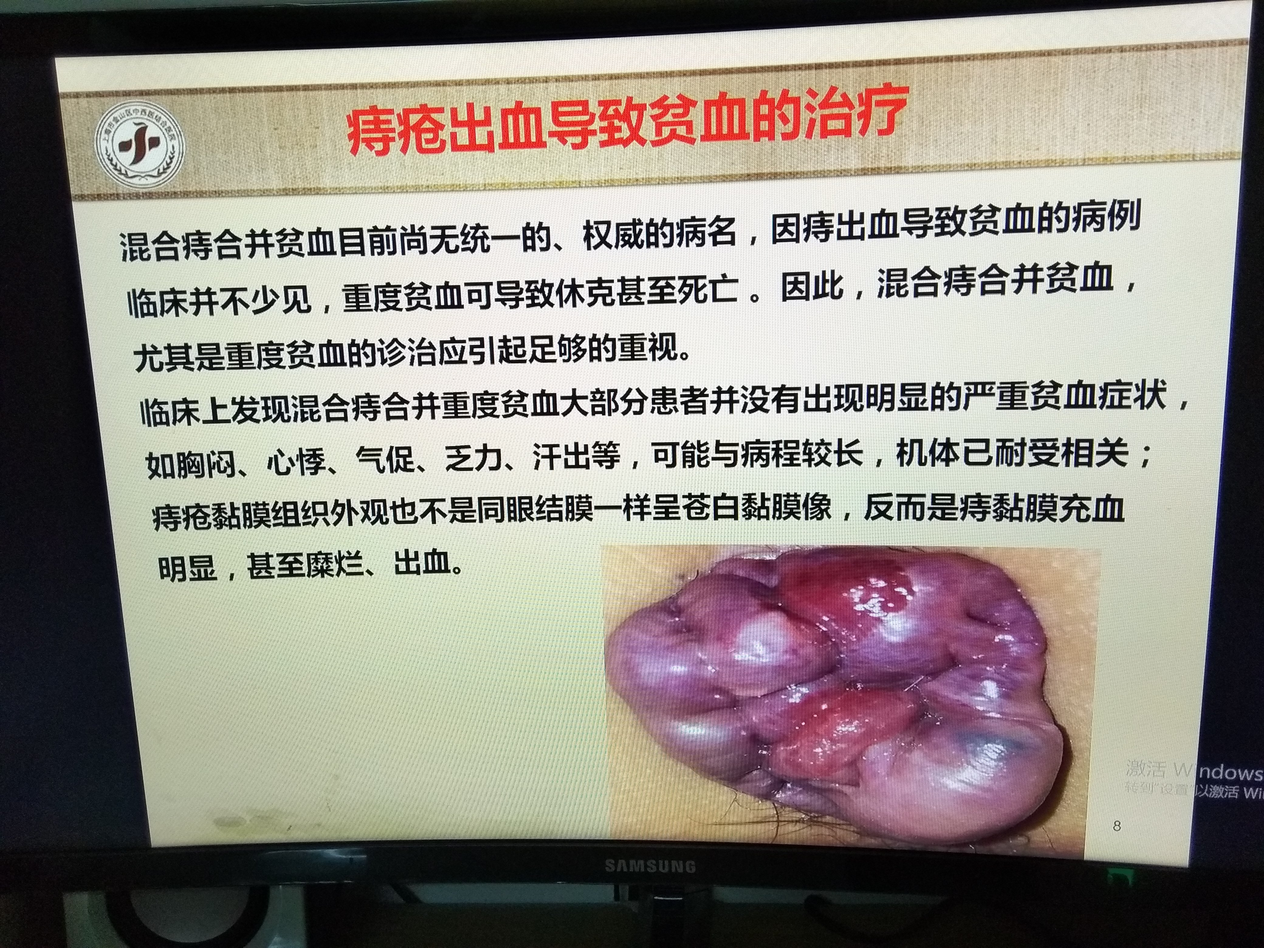 如何区别肠道出血和痔疮出血_肠道出血和痔疮出血_怎么区分痔疮出血和肠道出血