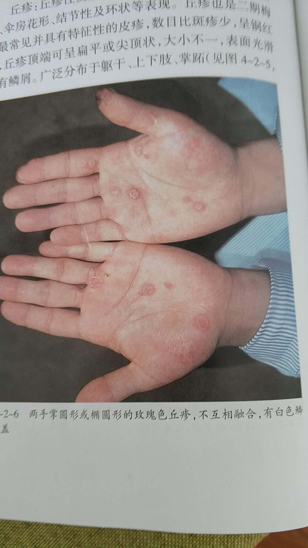 带你了解梅毒从传染到治疗的整个过程一期硬下疳 至于三期梅毒由于