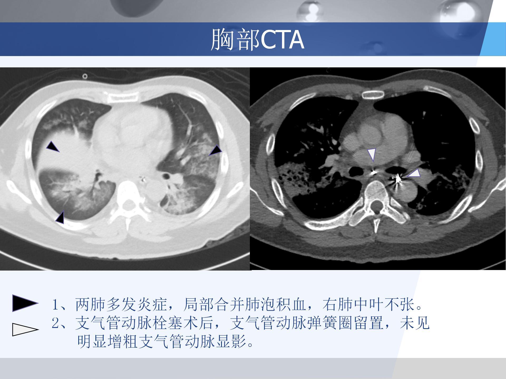 广医附一院-咯血病例汇报 [自动保存的]_04.jpg