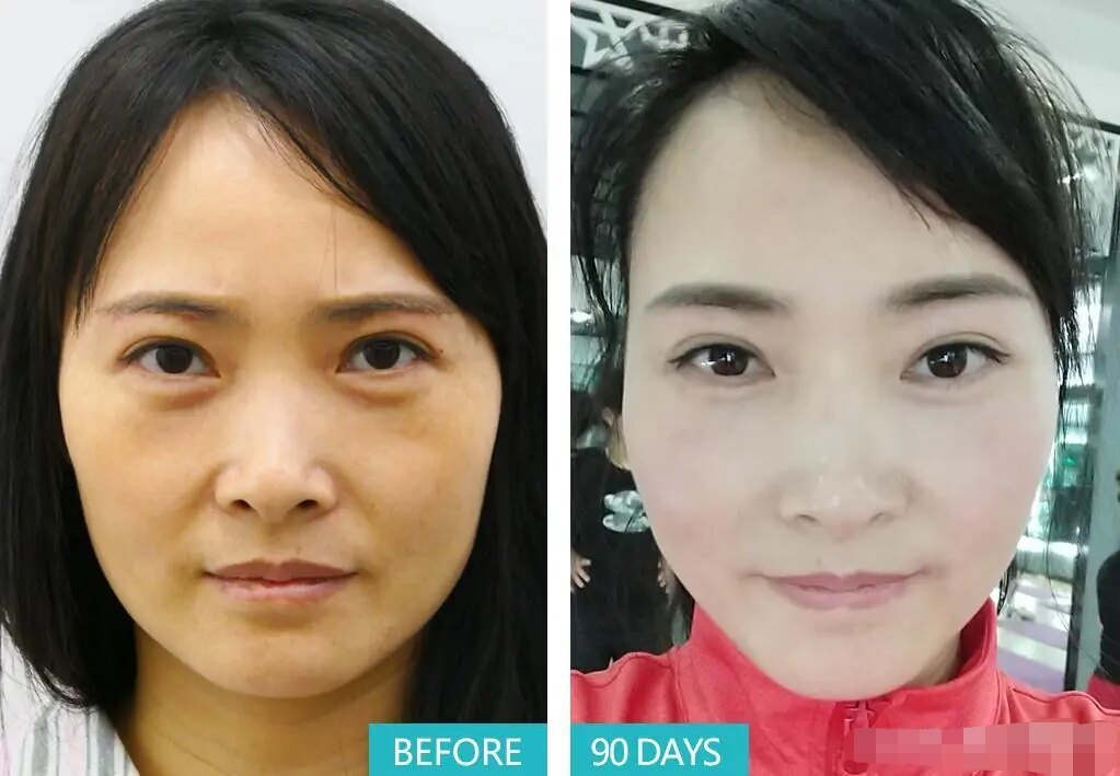 想要去眼袋,注意这两点不会"凹"!