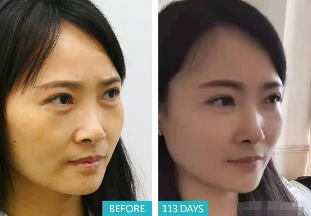 想要去眼袋,注意这两点不会"凹"!