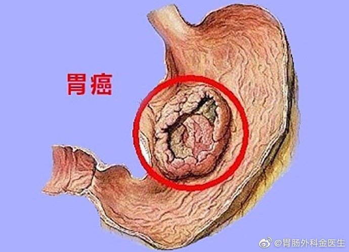胃癌的早期症状有哪些图片
