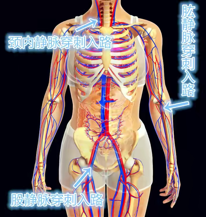 不同靜脈穿刺入路示意圖首先使用專用的細小穿刺針穿刺靜脈,可經股