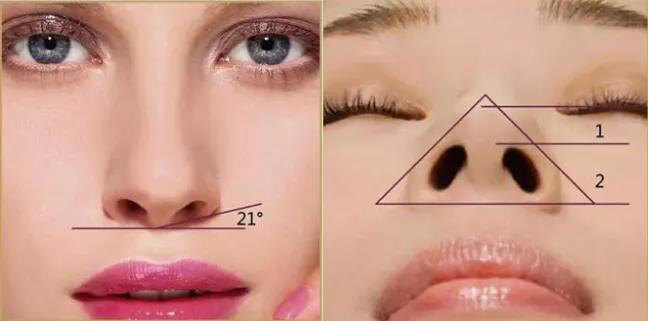 鼻基底凹陷怎么办?_鼻部整形_鼻部整形治疗介绍 - 好大夫在线