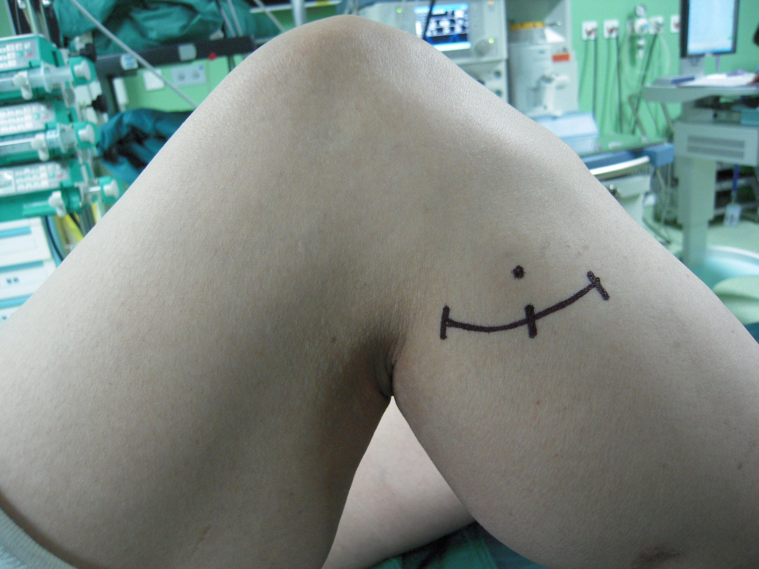 长此以往导致右膝腓总神经受压迫,一开始只是右小腿前外侧和脚背麻木