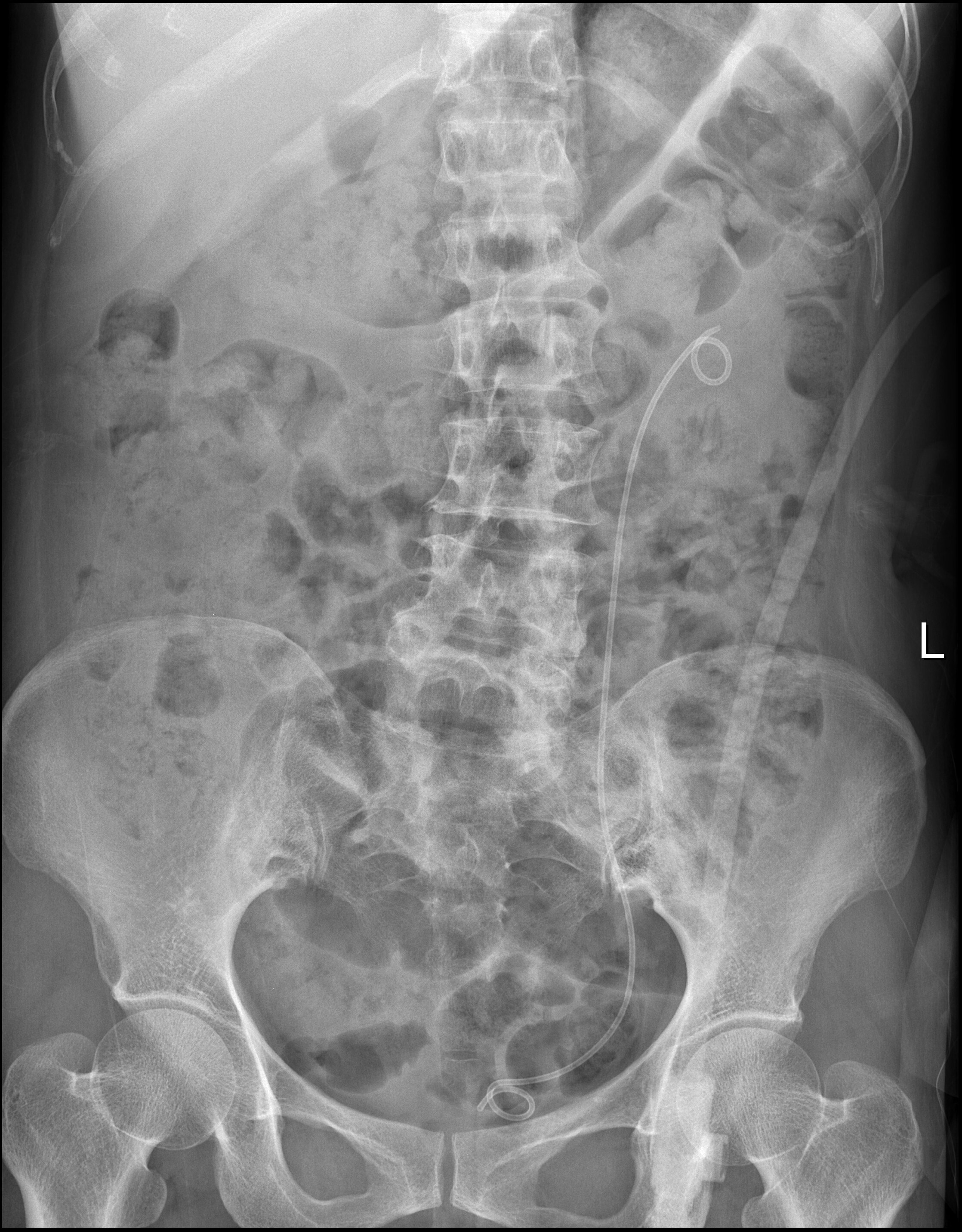 局麻微創取石腎結石輸尿管結石膀胱結石尿道結石局麻下輸尿管鏡軟鏡