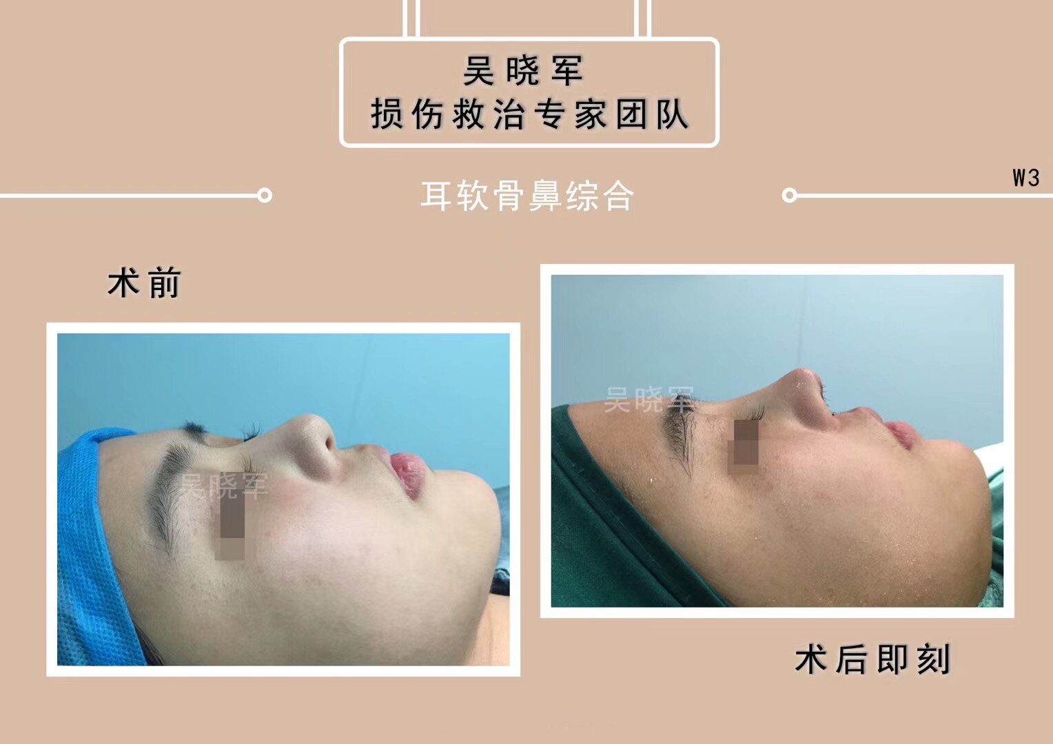 耳软骨鼻综合 鼻部整形 鼻部整形 耳软骨鼻综合 鼻部整形 鼻部整形