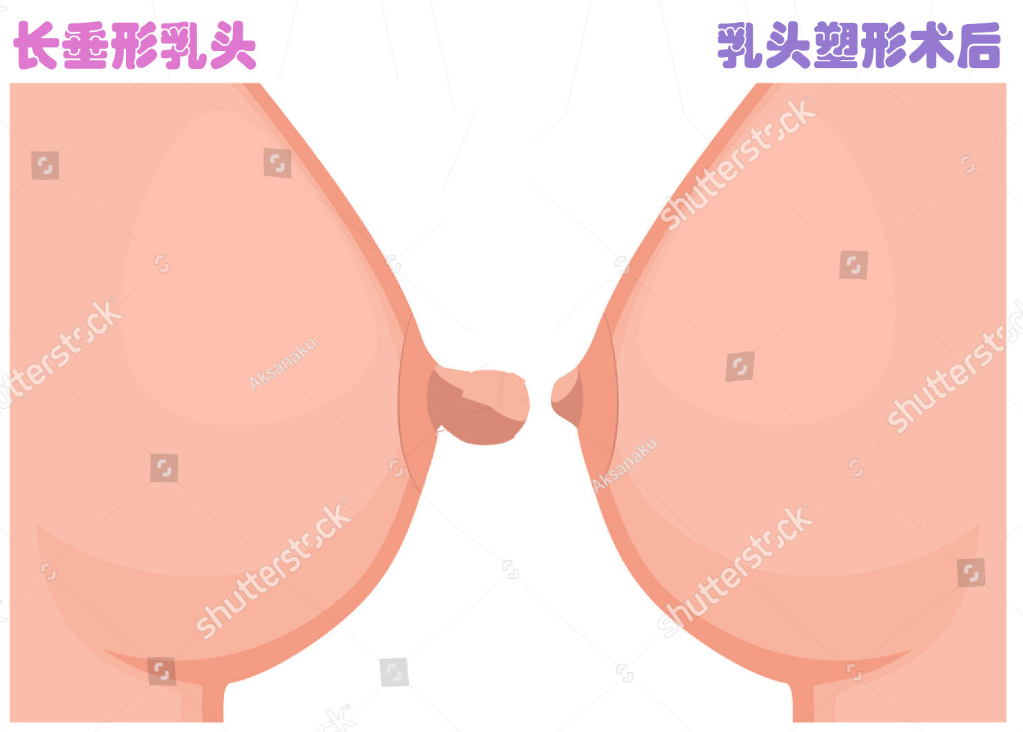 哺乳後乳房衰老三聯徵之乳頭肥大:乳頭縮小術