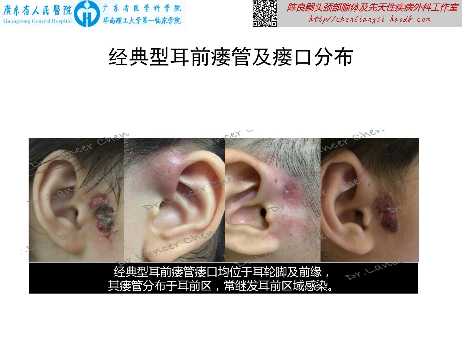 医学科普—耳前瘘管的b面:变异型_先天性耳前瘘管_先天性耳前瘘管