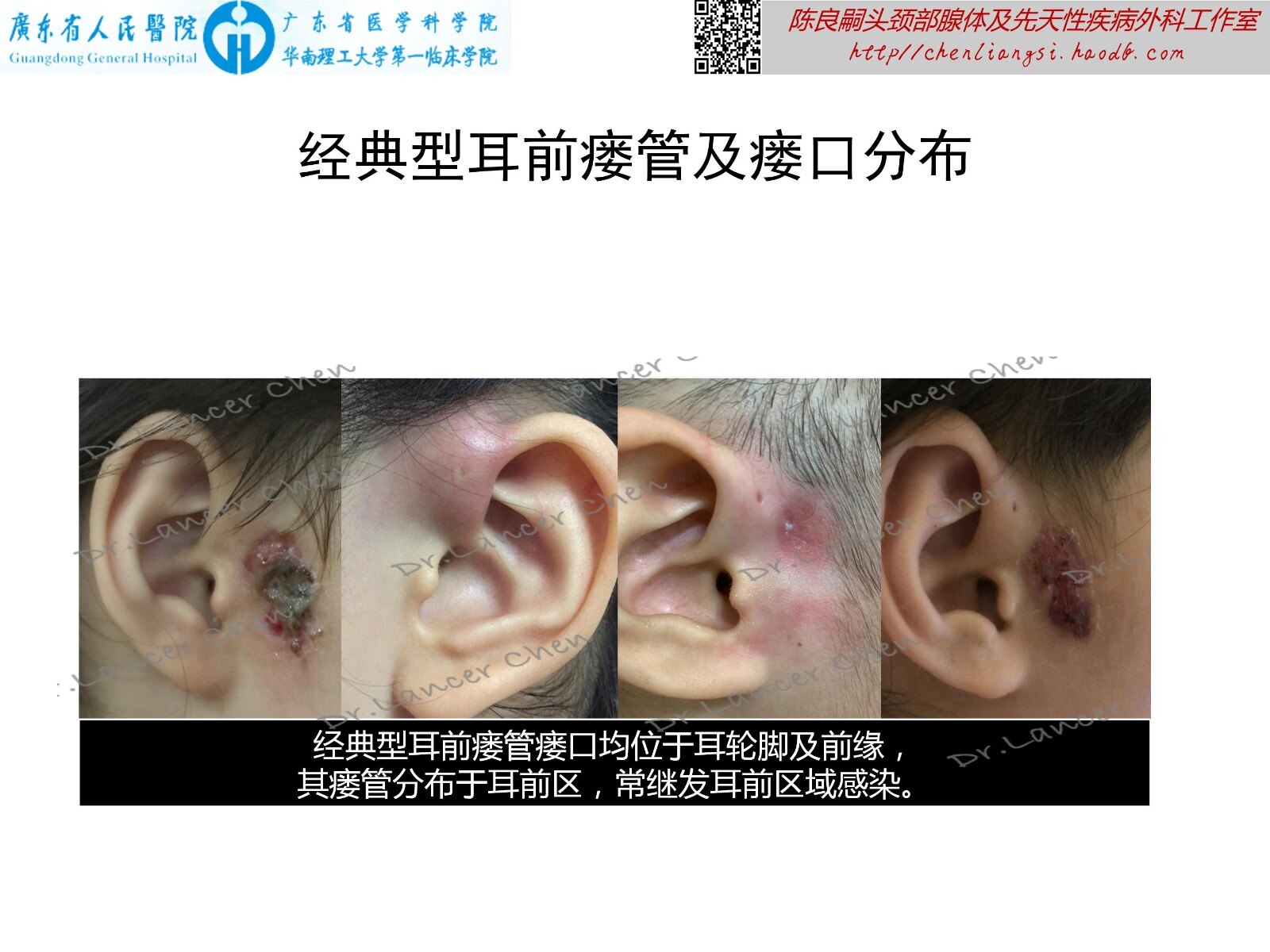 医学科普 耳前瘘管的b面 变异型 先天性耳前瘘管 先天性耳前瘘管 医学科普 耳前瘘管的b面 变异型 先天性耳前瘘管 先天性耳前瘘管