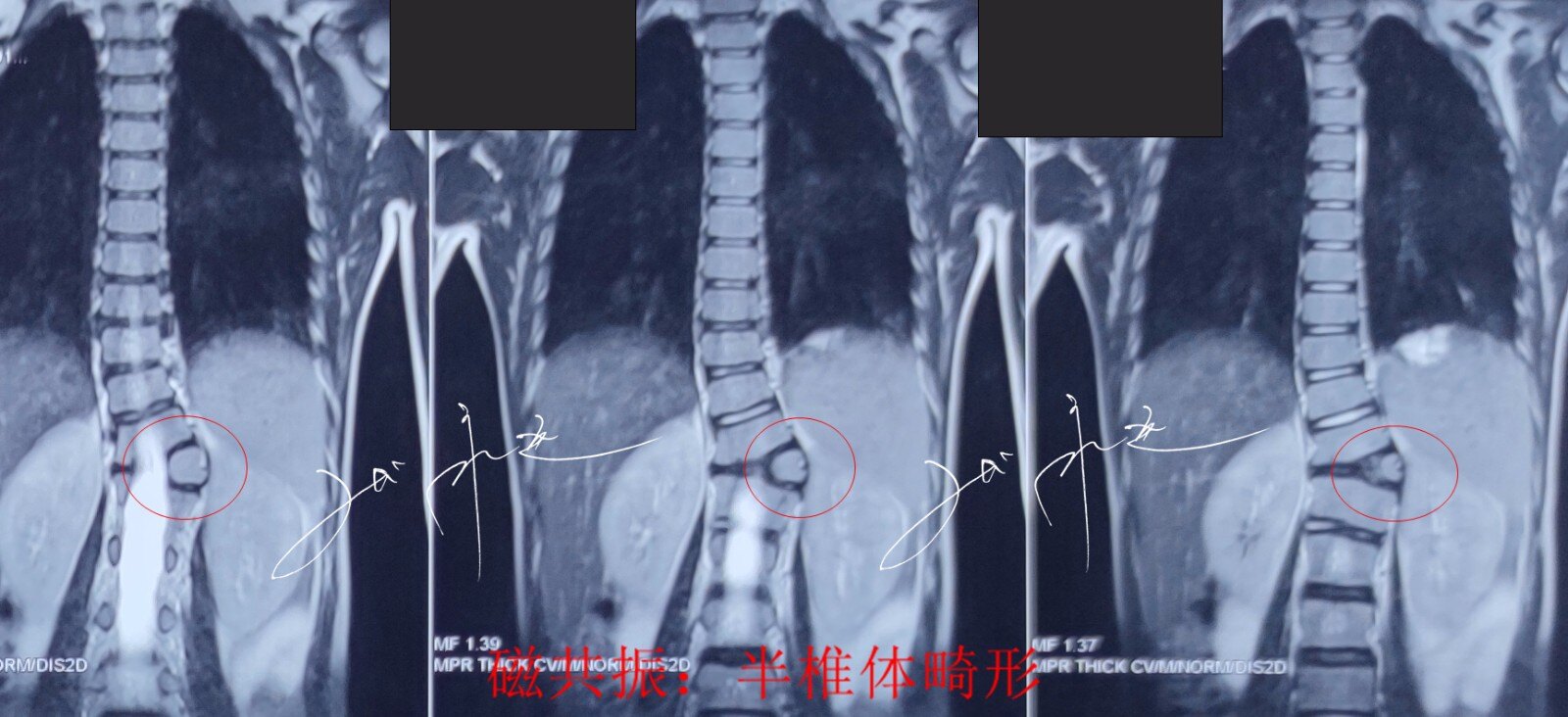 ct檢查如圖:10歲男孩,因洗澡時發現兩側肩胛骨不等高,彎腰時胸背部有