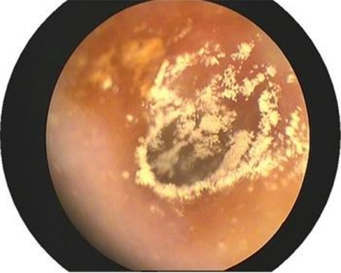耳朵白色霉菌照片图片
