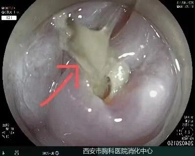 骨鯁在喉,消化內鏡顯身手_咽部異物_咽部異物治療方式 - 好大夫在線