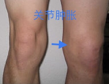 膝关节疾病之滑膜炎 滑膜炎 滑膜炎