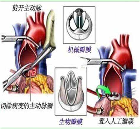 什麼是主動脈瓣二葉化畸形怎樣治療