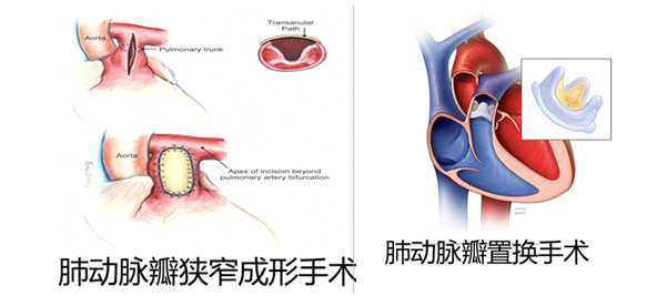 什麼是肺動脈瓣狹窄?需要手術嗎?