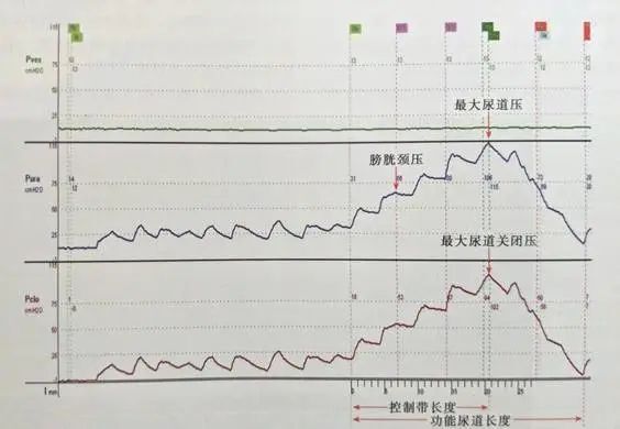 尿动力学检查意义真的很重要!