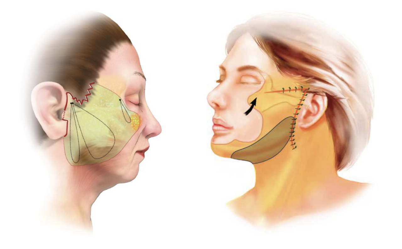 面部提升（拉皮）的抗衰效果怎么样？哪些医生擅长面部拉皮手术？ - 知乎