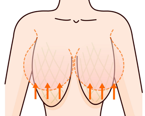 女性乳房发育不良图片