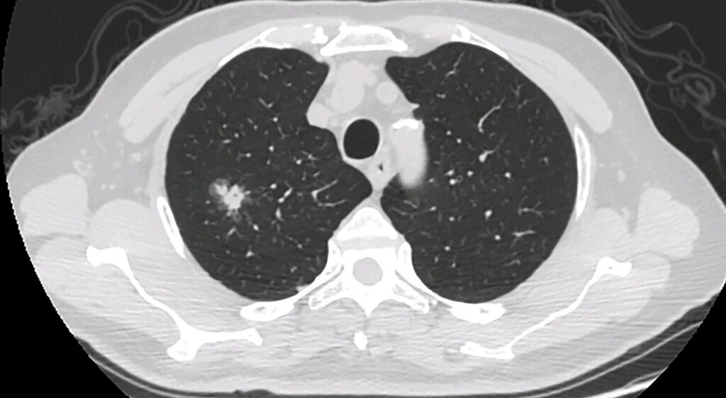 磨玻璃结节 磨玻璃结节