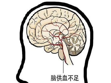 慢性脑供血不足常伴焦虑,抑郁和不良行为模式