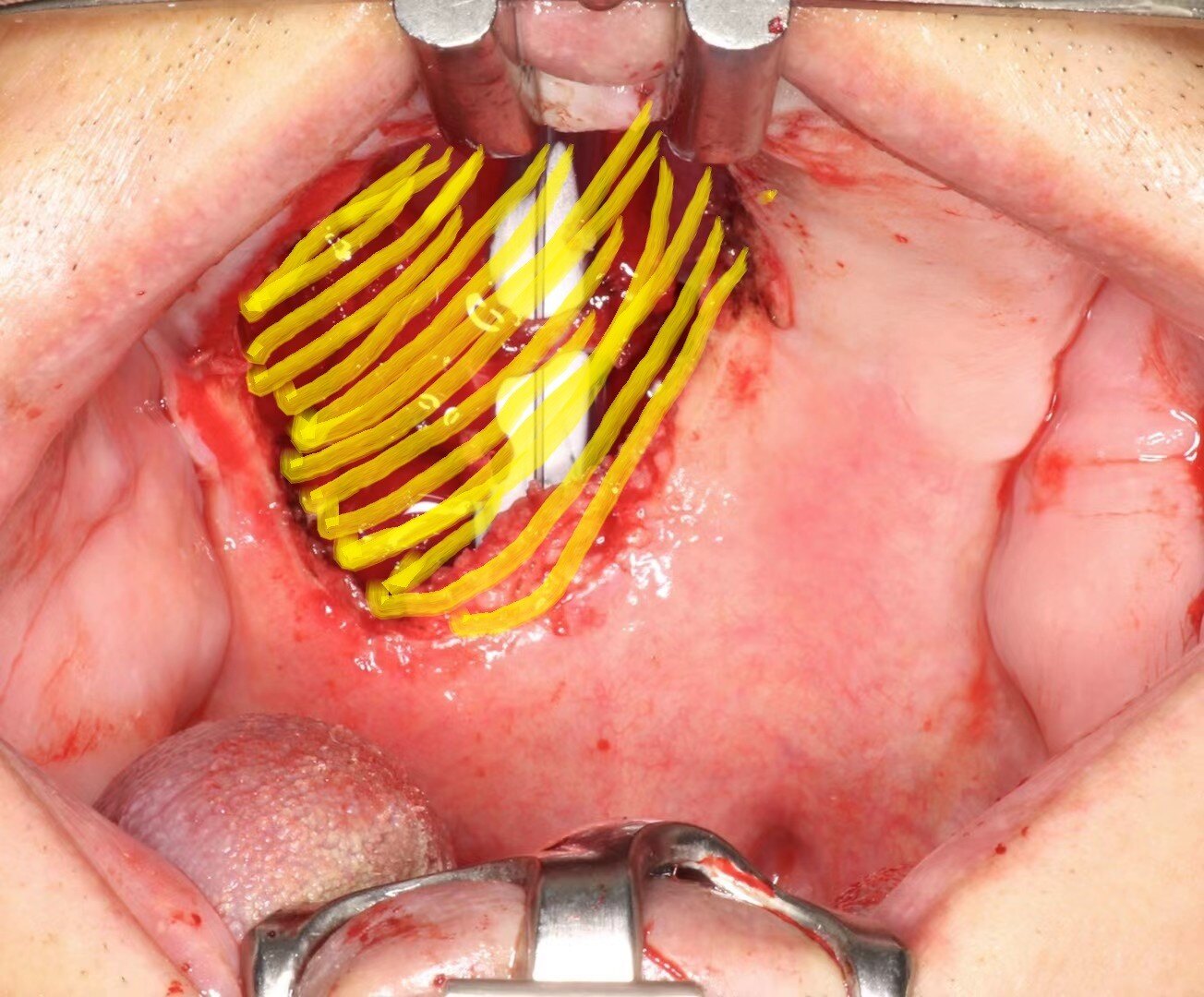 口腔上颚肿瘤图片