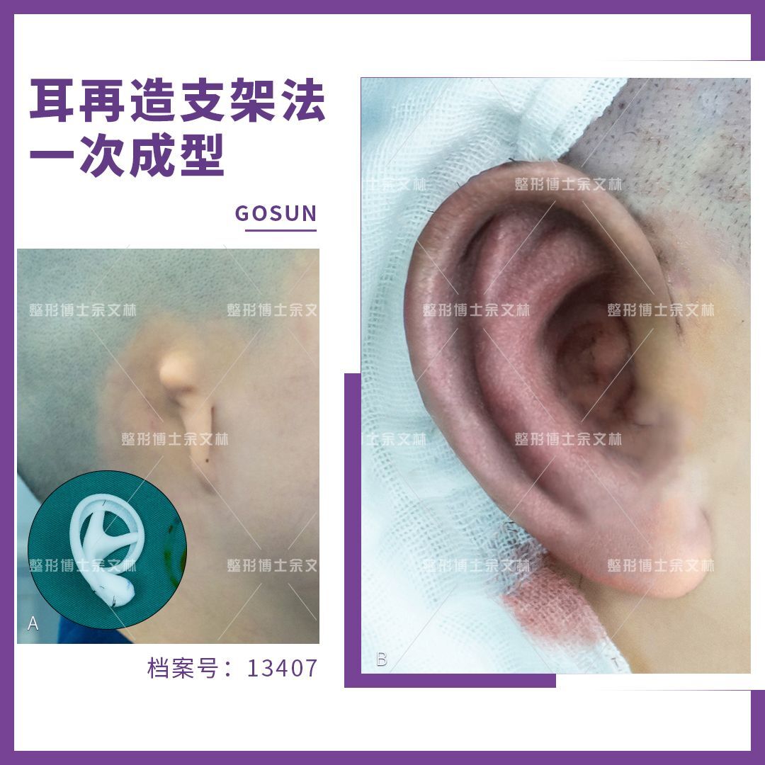 假耳朵再造怎么做耳再造专家余文林解答
