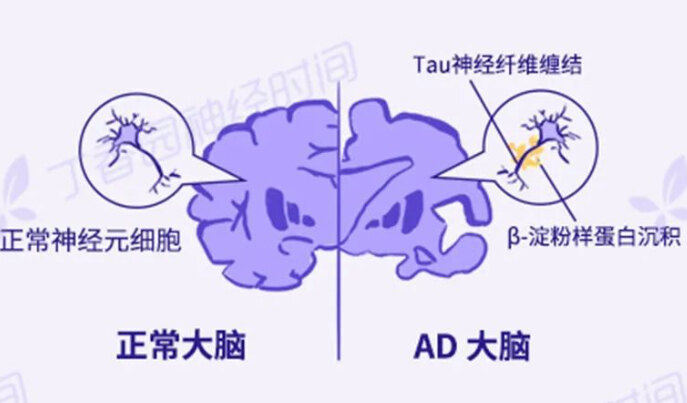阿尔茨海默病（AD）各阶段该如何应对？_老年痴呆(阿尔茨海默病)_症状表现_治疗方式 - 好大夫在线