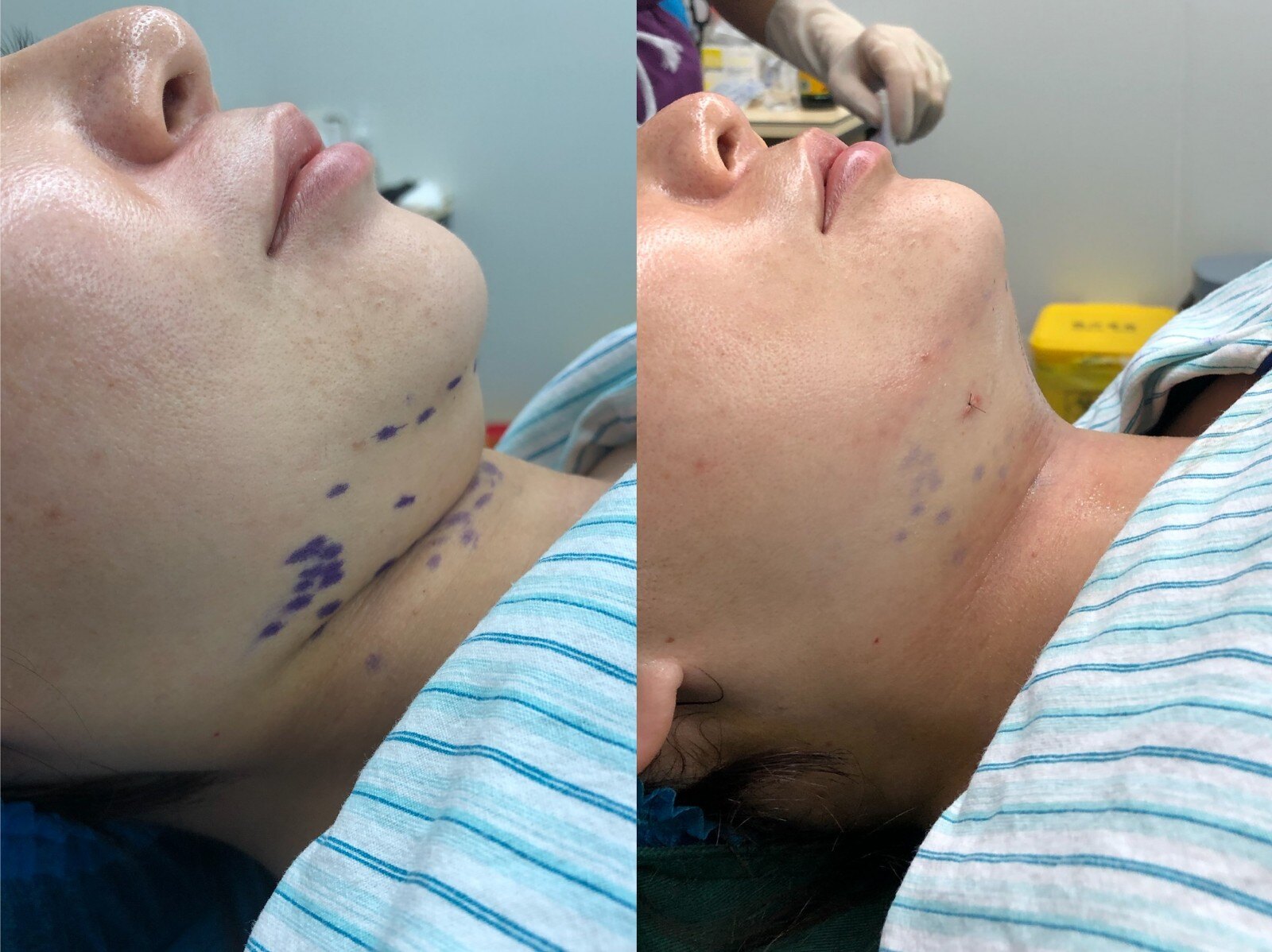 【刀锋论坛---吸脂】 维密脂雕治疗双下巴----微创,安全,快速,有效!