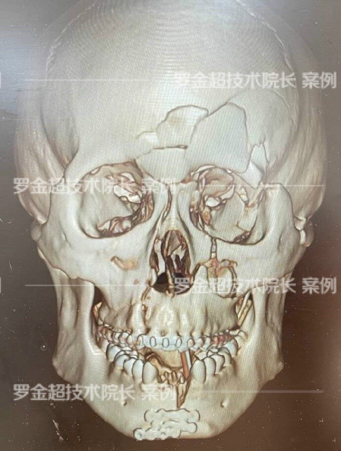 綜合各方面因素考慮後,決定先做了下頜骨折內固定,上頜用牙弓夾板外