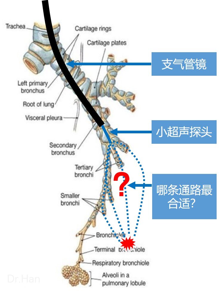 气管镜进镜技巧图解图片