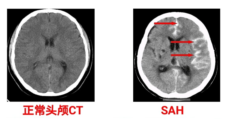 颅内动脉瘤ct表现图片
