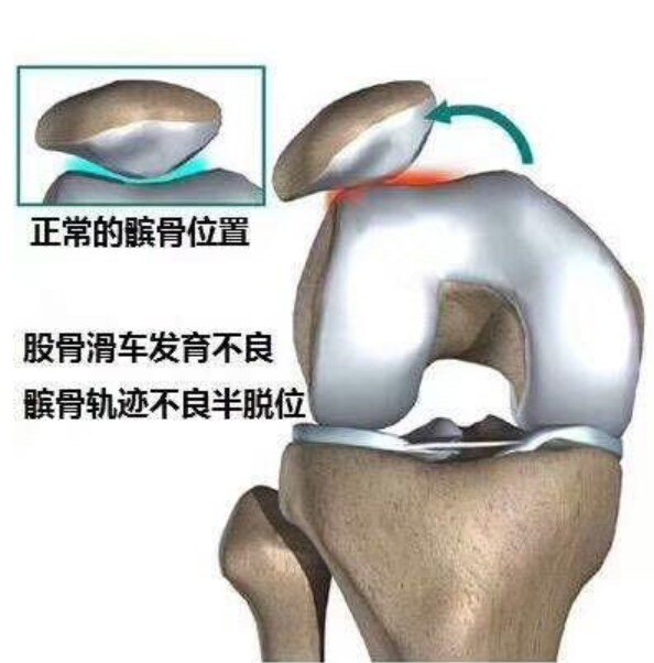 怎么看膝盖的磨损程度 yoYBAGB-YOqAfQfXAADS2--_Cxo657.jpg?_ms_=ed12