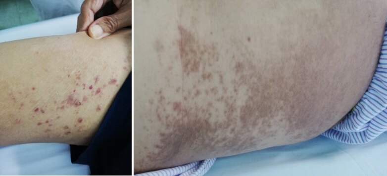 真实病例分析疗效显著耐受性佳替雷利珠单抗联合化疗新辅助治疗转移性