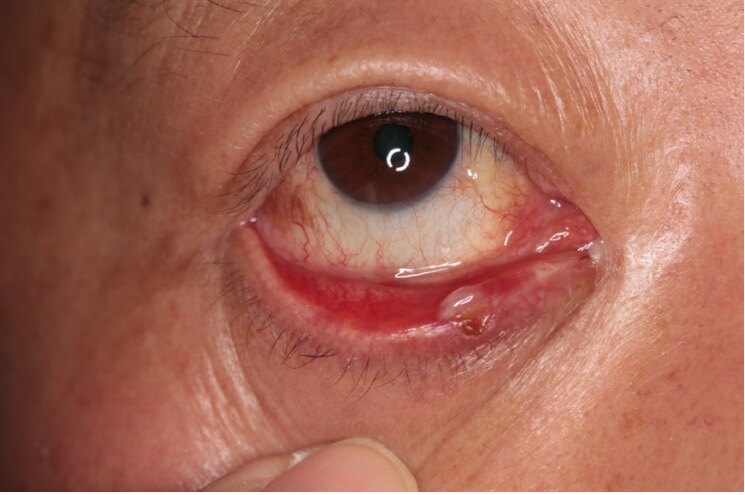 小儿眼部血管瘤图片图片